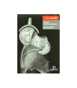 CHOQUE FEMOROACETABULAR