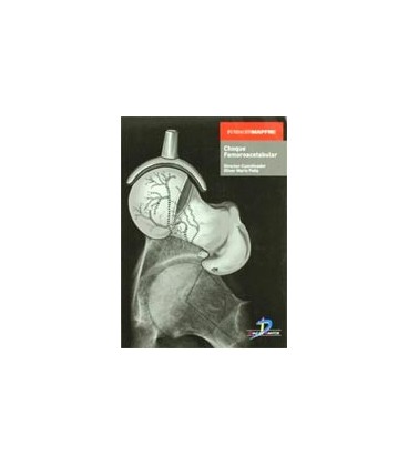 CHOQUE FEMOROACETABULAR